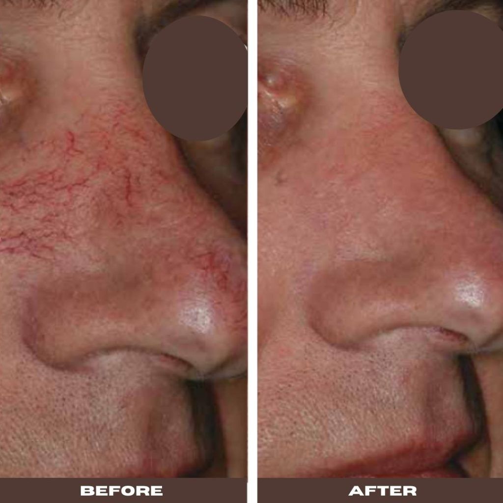 Thread Vein Treatment