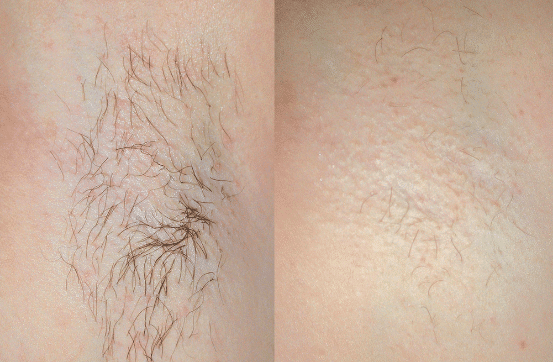 About the introduction of ND YAG laser hair removal