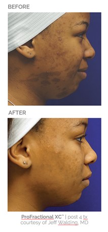 Debunking 5 Common Myths About Treating Skin Of Color With Lasers