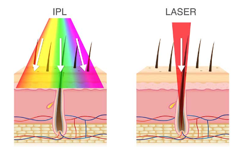 IPL and Laser for Hair Removal: What’s the Difference?