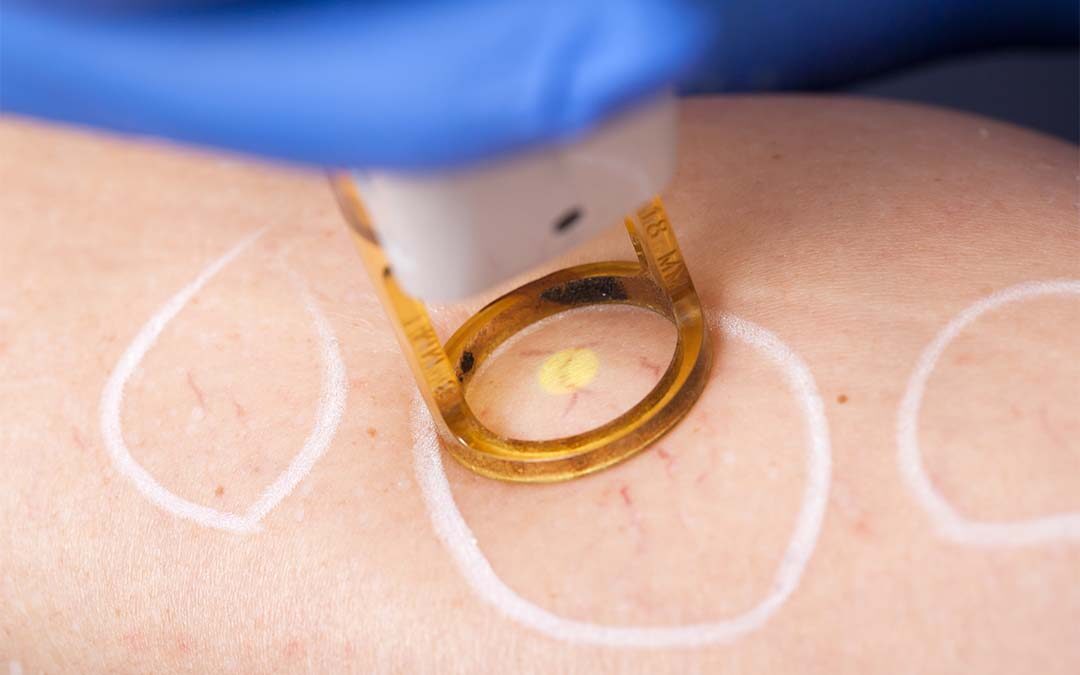 IPL laser for spider veins and varicose veins