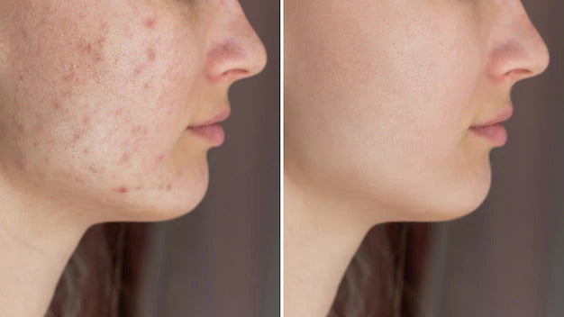 Acne Scar