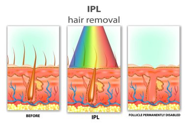 IPL (Intense Pulsed Light). How IPL Hair Removal Works — Vector