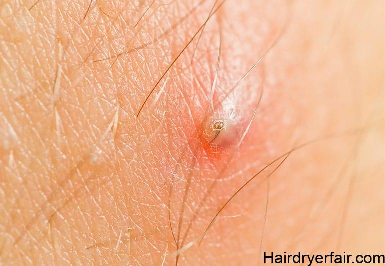 What is Best for Ingrown Hair: The Complete Guide 1