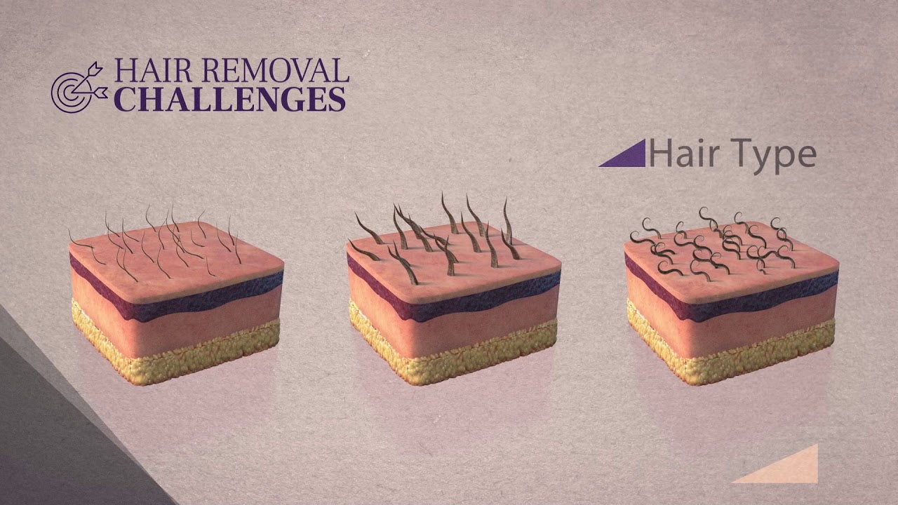 Laser Hair Removal Brisbane