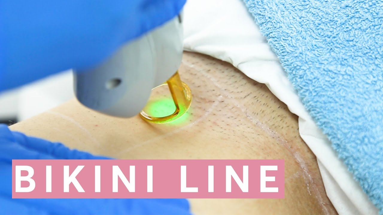 The Very Best Type Of Lasers Hair Removal Therapies