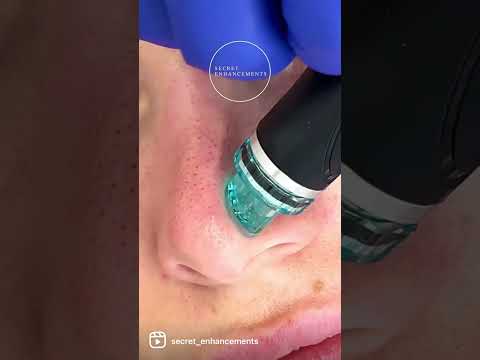 Hollywood Microneedling