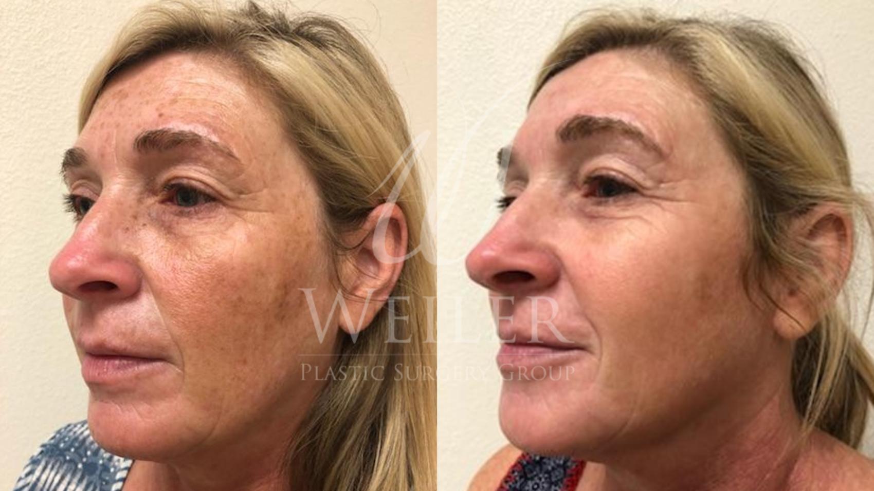 Before & After IPL Photorejuvenation Case 434 View #1 View in Baton Rouge, New Orleans, & Lafayette, Louisiana