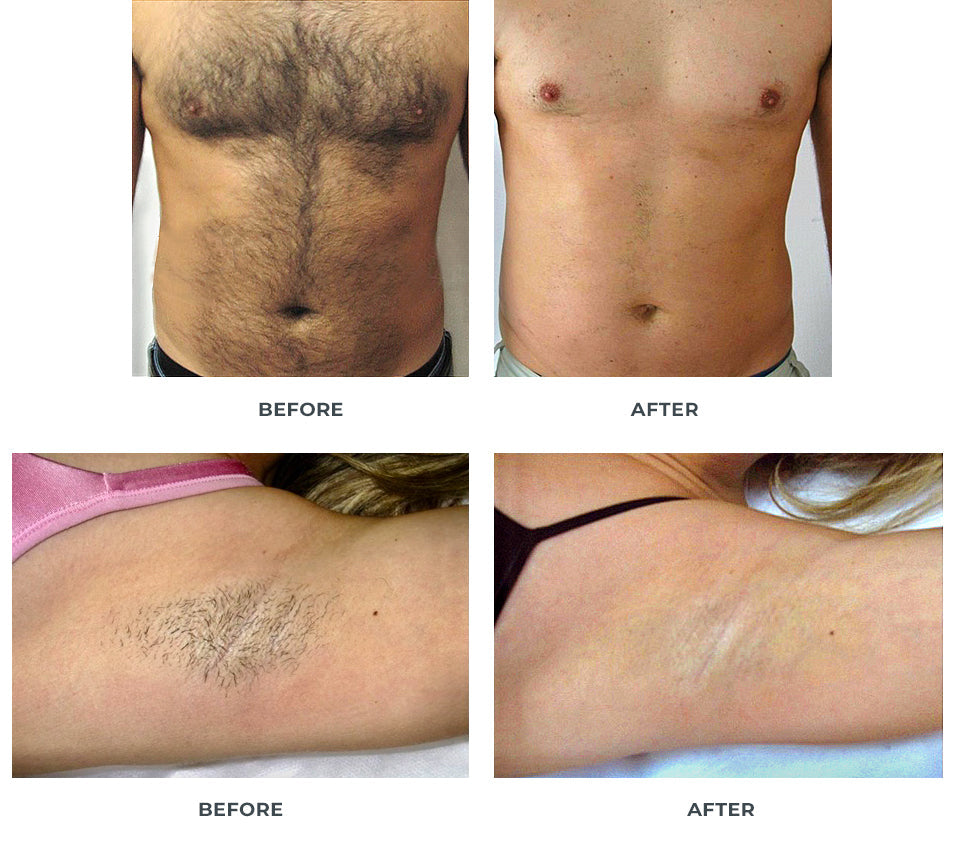 What Does Laser Hair Removal Raleigh Nc Mean?