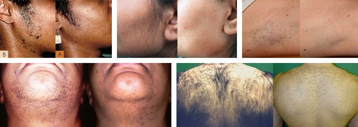 Laser hair reduction for unwanted hair ( NdYag laser) ----