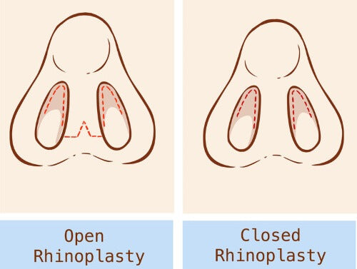closed and open rhinoplasty